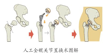 髋关节,置换术,四川赫尔森康复医院,雷春